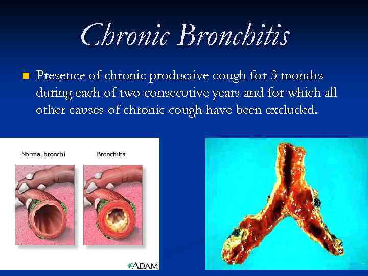 Chronic Bronchitis n Presence of chronic productive cough for 3 months during each of