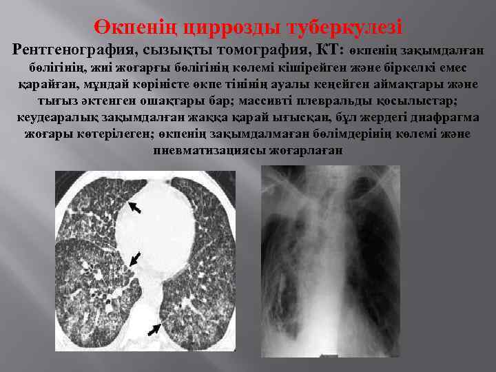 Өкпенің циррозды туберкулезі Рентгенография, сызықты томография, КТ: өкпенің зақымдалған бөлігінің, жиі жоғарғы бөлігінің көлемі