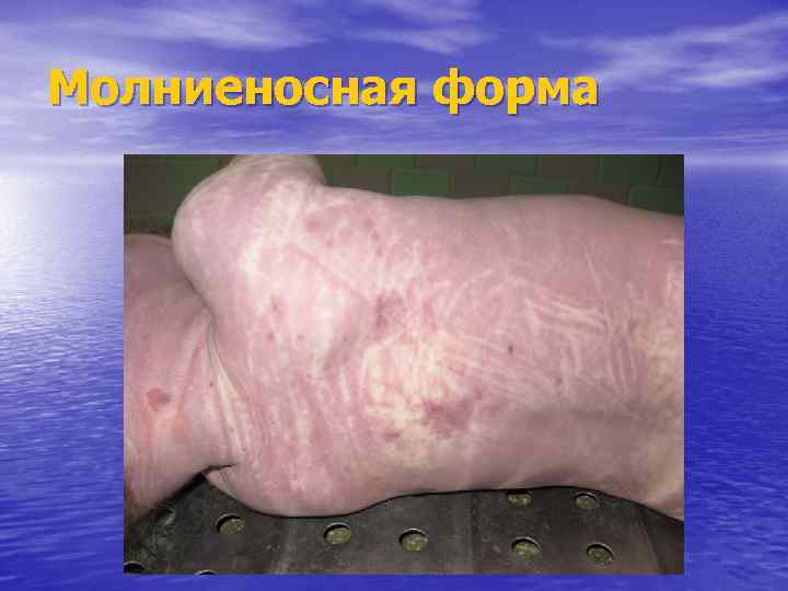 Молниеносная форма 