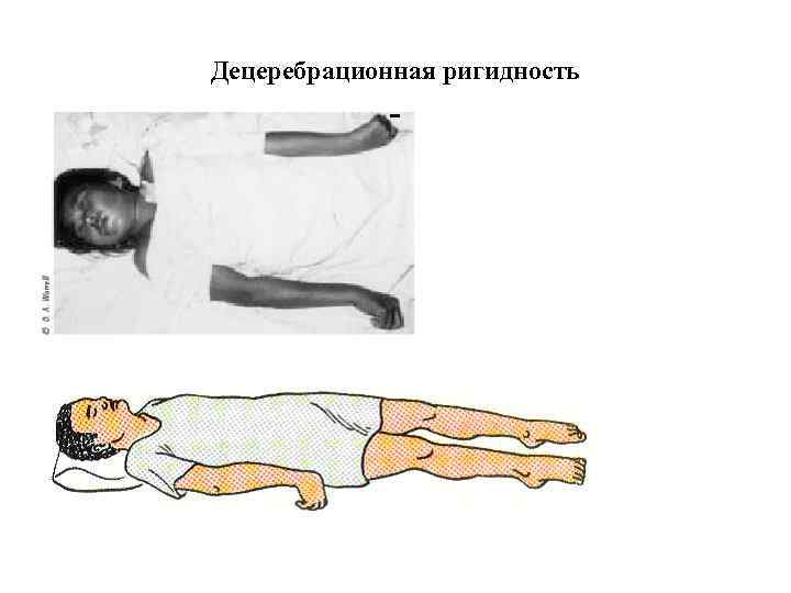 Децеребрационная ригидность 