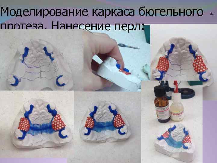 Моделирование каркаса бюгельного протеза. Нанесение перл: 21 