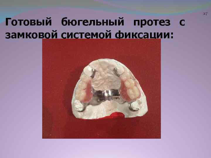 Готовый бюгельный протез с замковой системой фиксации: 27 