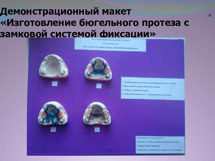 Демонстрационный макет «Изготовление бюгельного протеза с замковой системой фиксации» 28 