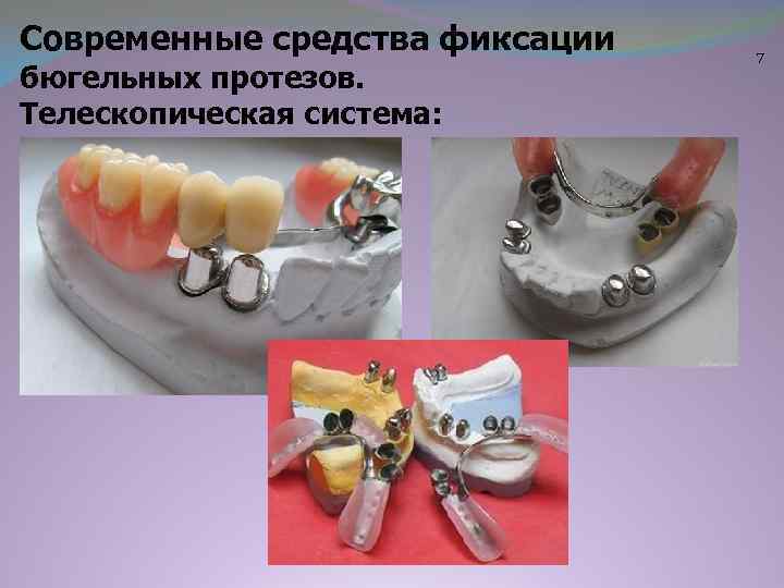 Современные средства фиксации бюгельных протезов. Телескопическая система: 7 