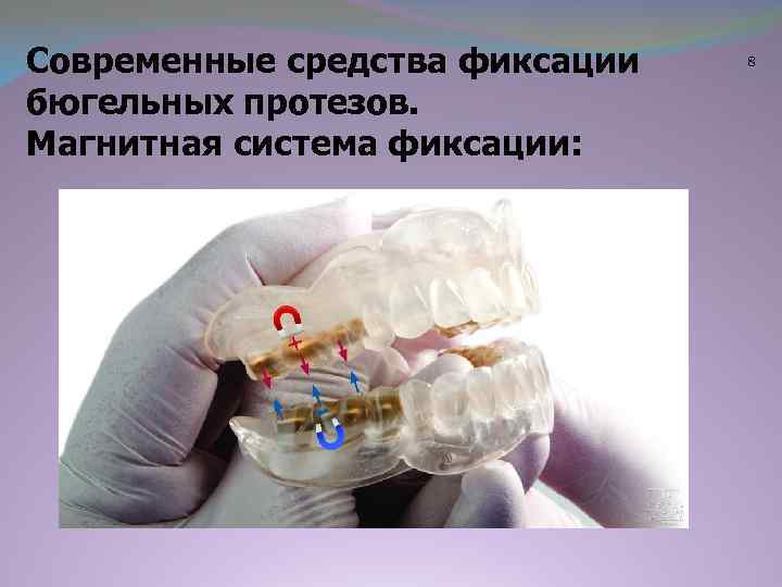 Современные средства фиксации бюгельных протезов. Магнитная система фиксации: 8 