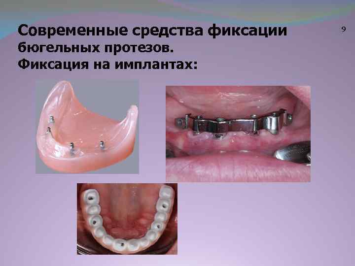 Современные средства фиксации бюгельных протезов. Фиксация на имплантах: 9 