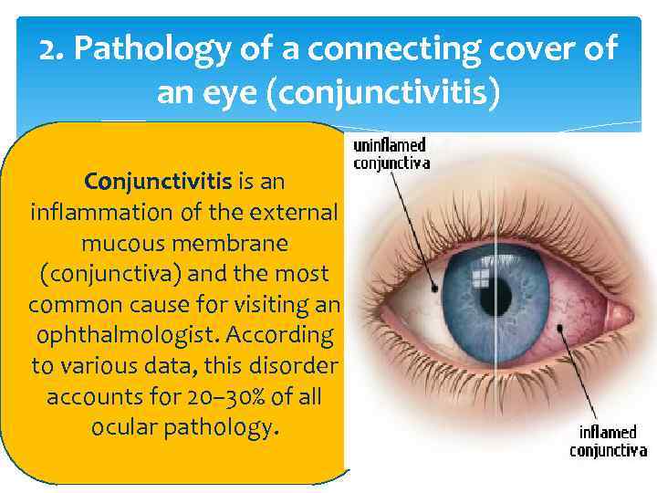 2. Pathology of a connecting cover of an eye (conjunctivitis) Conjunctivitis is an inflammation
