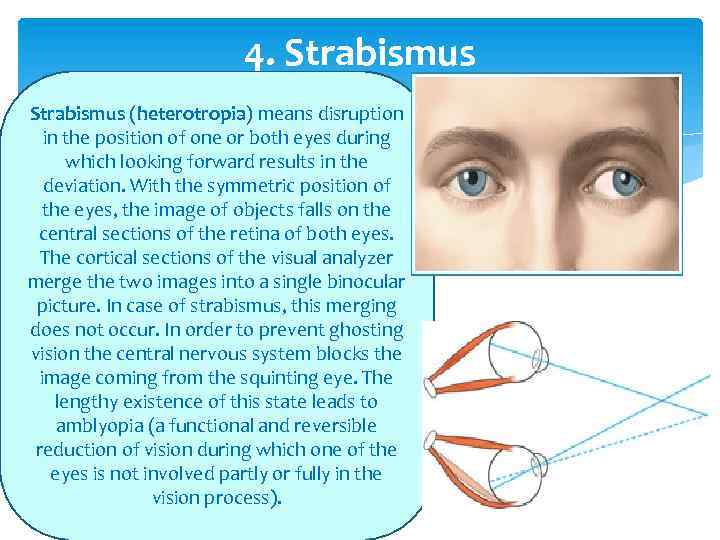 4. Strabismus (heterotropia) means disruption in the position of one or both eyes during