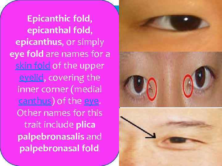 Epicanthic fold, epicanthal fold, epicanthus, or simply eye fold are names for a skin