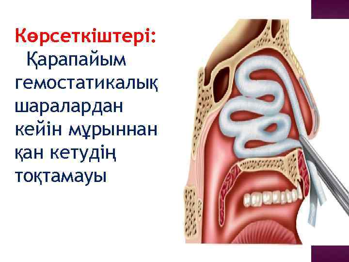 Көрсеткіштері: Қарапайым гемостатикалық шаралардан кейін мұрыннан қан кетудің тоқтамауы 