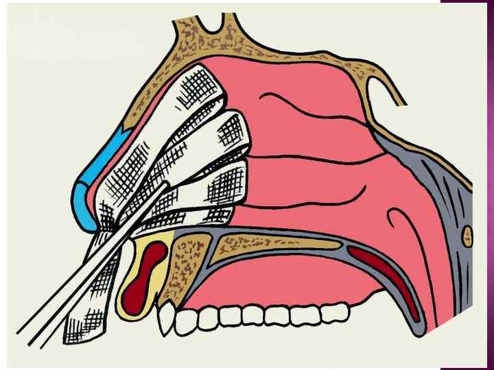 Артқы тампонада 60 -80% Алдыңғы тампонада 90 -95% 