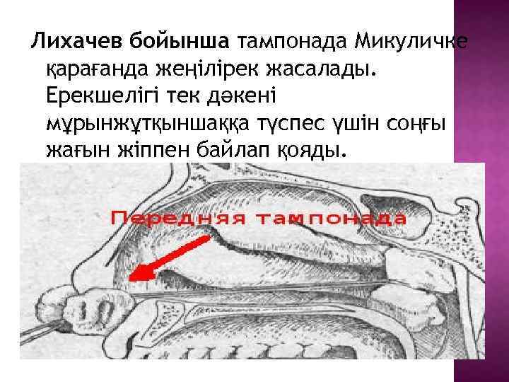 Лихачев бойынша тампонада Микуличке қарағанда жеңілірек жасалады. Ерекшелігі тек дәкені мұрынжұтқыншаққа түспес үшін соңғы