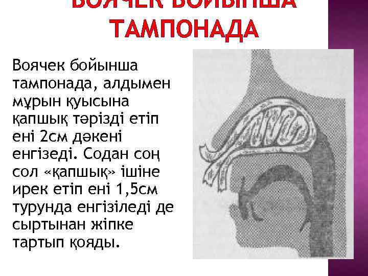 ВОЯЧЕК БОЙЫНША ТАМПОНАДА Воячек бойынша тампонада, алдымен мұрын қуысына қапшық тәрізді етіп ені 2