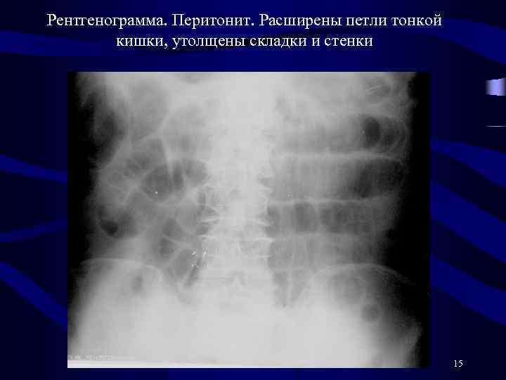 Рентгенограмма. Перитонит. Расширены петли тонкой кишки, утолщены складки и стенки 15 