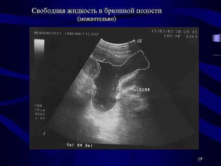 Свободная жидкость в брюшной полости (межпетельно) 19 