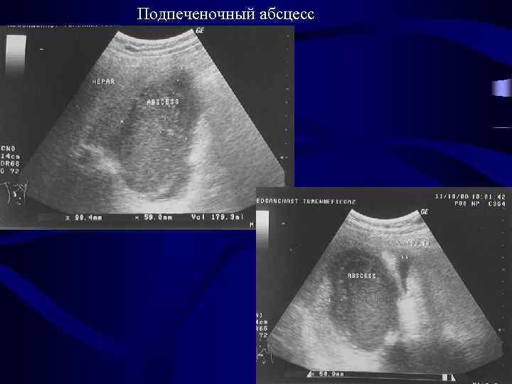Подпеченочный абсцесс 24 