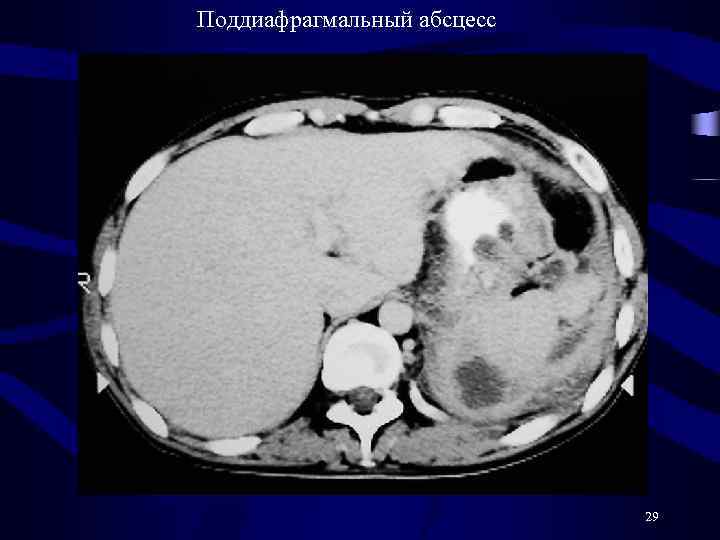 Поддиафрагмальный абсцесс 29 