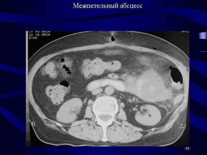  Межпетельный абсцесс 30 