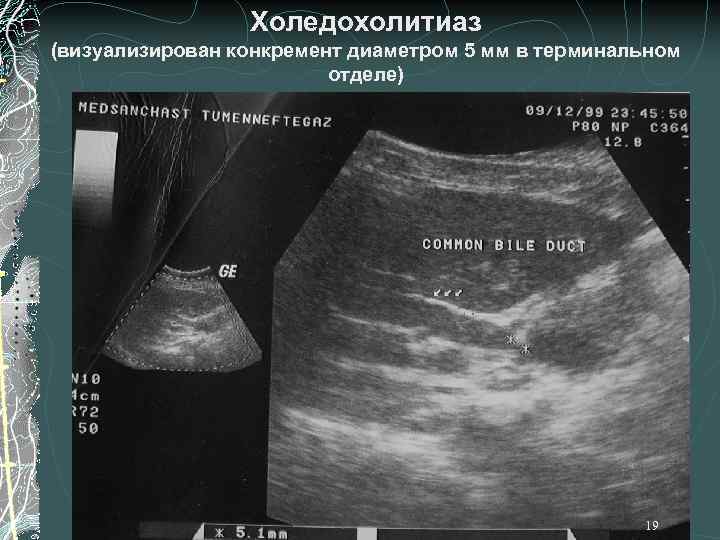 Холедохолитиаз (визуализирован конкремент диаметром 5 мм в терминальном отделе) 19 