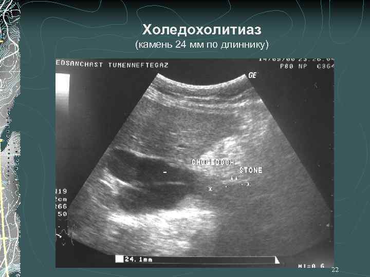 Холедохолитиаз (камень 24 мм по длиннику) 22 