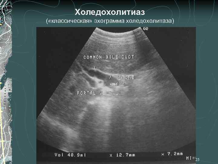 Холедохолитиаз ( «классическая» эхограмма холедохолитаза) 25 