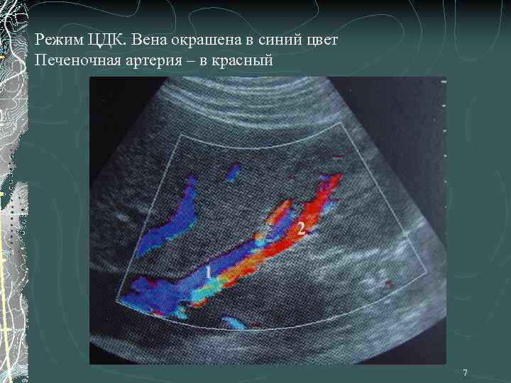 Режим ЦДК. Вена окрашена в синий цвет Печеночная артерия – в красный 7 