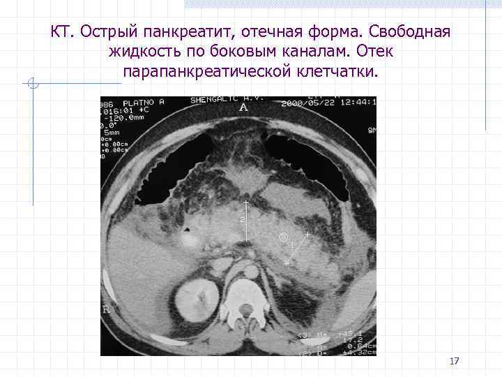 КТ. Острый панкреатит, отечная форма. Свободная жидкость по боковым каналам. Отек парапанкреатической клетчатки. 17