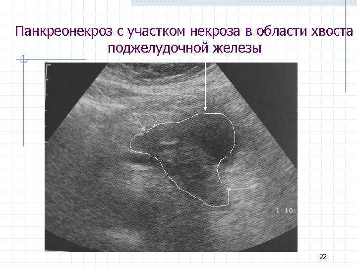 Панкреонекроз с участком некроза в области хвоста поджелудочной железы 22 