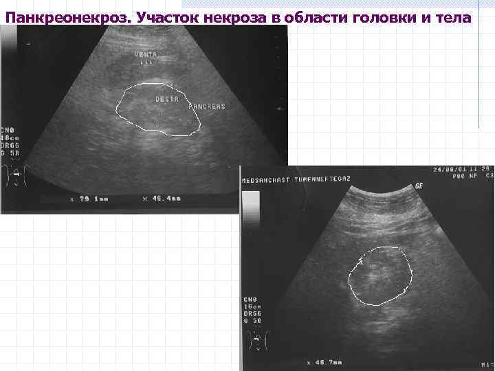 Панкреонекроз. Участок некроза в области головки и тела 25 