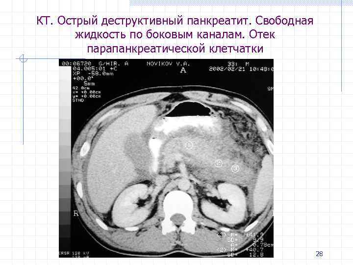 КТ. Острый деструктивный панкреатит. Свободная жидкость по боковым каналам. Отек парапанкреатической клетчатки 28 