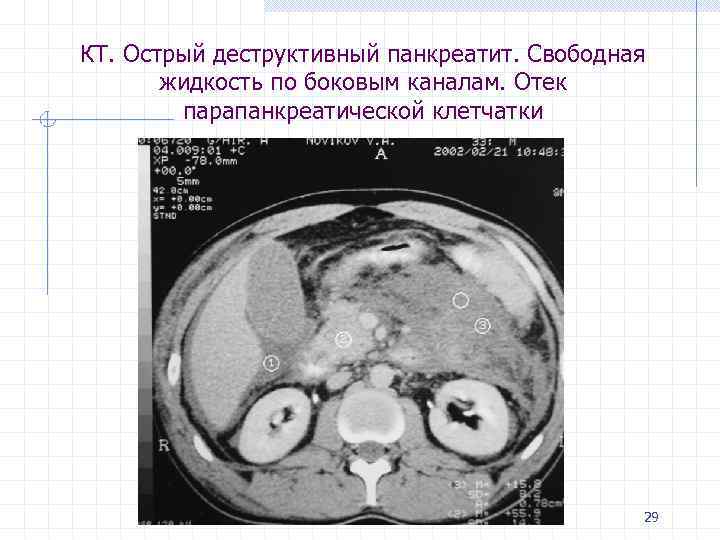 КТ. Острый деструктивный панкреатит. Свободная жидкость по боковым каналам. Отек парапанкреатической клетчатки 29 