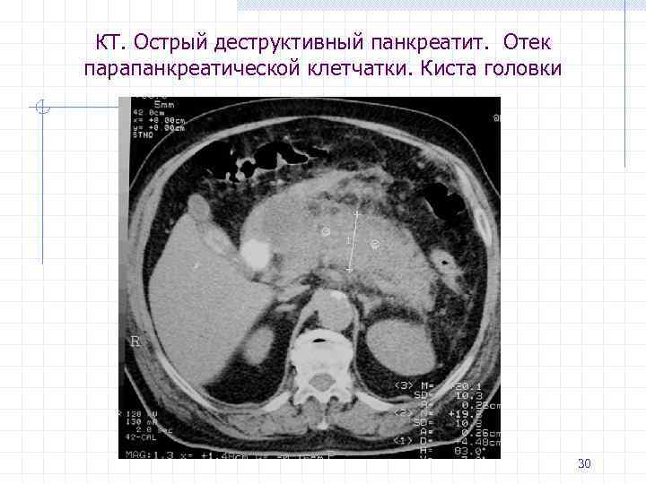 Кт картина острого панкреатита