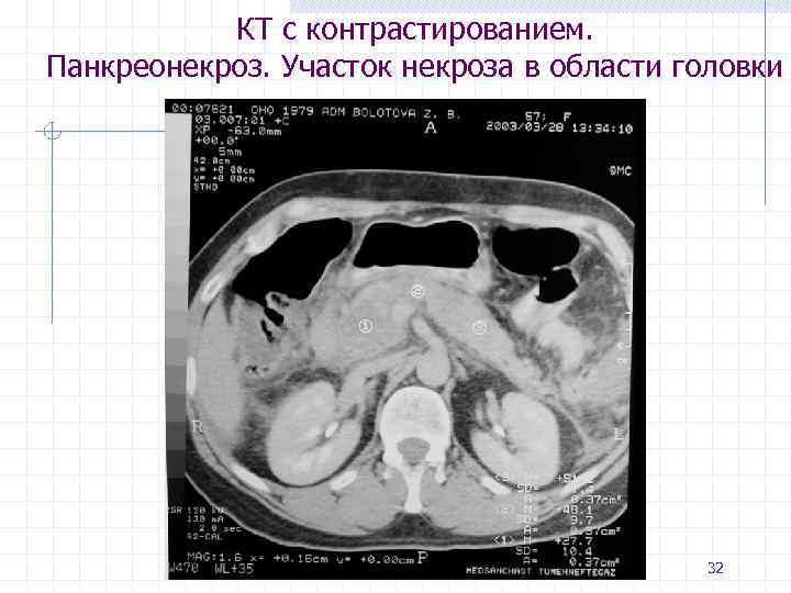 КТ с контрастированием. Панкреонекроз. Участок некроза в области головки 32 