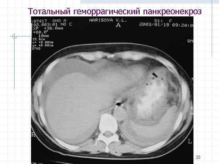 Код мкб панкреонекроз. Панкреонекроз УЗИ картина. УЗИ при панкреонекрозе. Геморрагический панкреонекроз гистология.