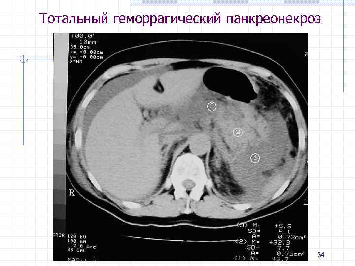 Тотальный геморрагический панкреонекроз 34 