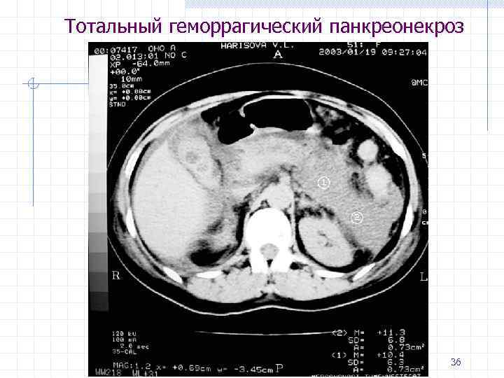 Тотальный геморрагический панкреонекроз 36 