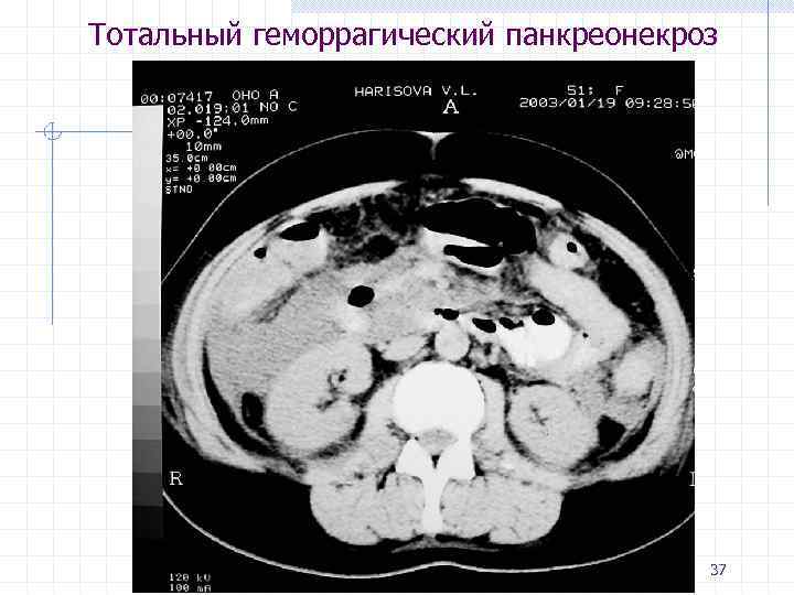 Панкреонекроз рекомендации