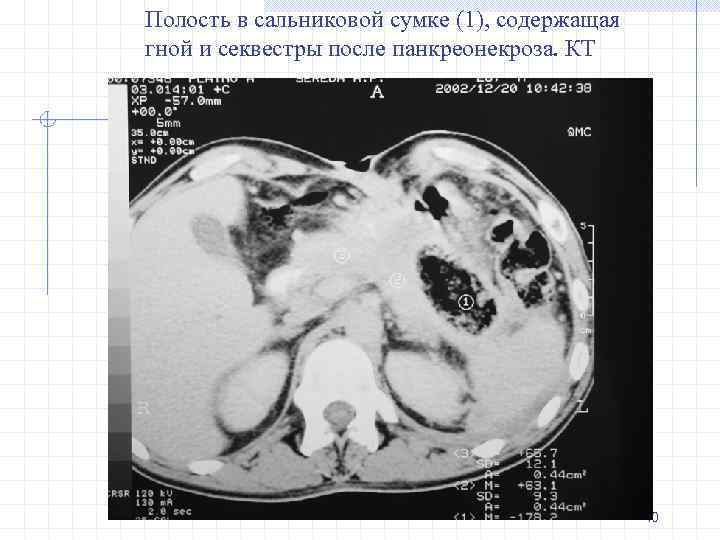 Полость в сальниковой сумке (1), содержащая гной и секвестры после панкреонекроза. КТ 40 