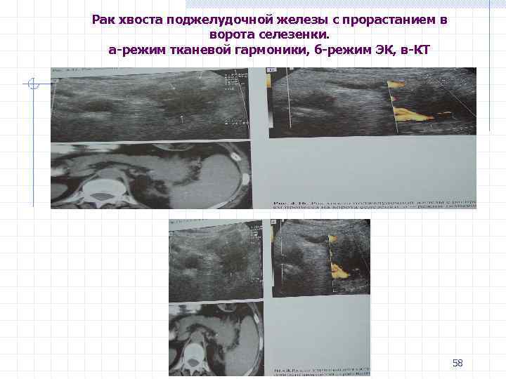 Рак хвоста поджелудочной железы с прорастанием в ворота селезенки. а-режим тканевой гармоники, б-режим ЭК,