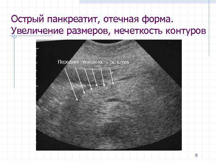 Для молочной железы женщины старше 50 лет наиболее характерна следующая ультразвуковая картина