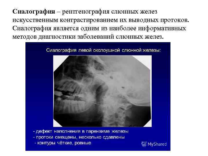 Сиалография – рентгенография слюнных желез искусственным контрастированием их выводных протоков. Сиалография является одним из