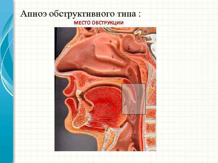 Апноэ обструктивного типа : МЕСТО ОБСТРУКЦИИ 