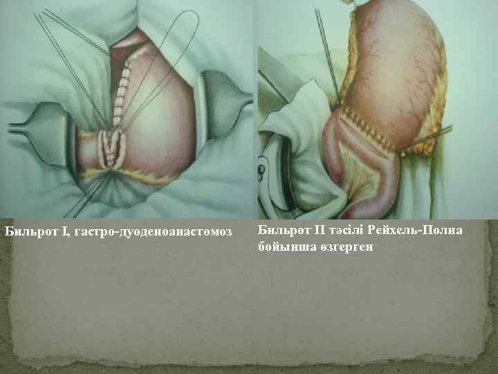 Бильрот I, гастро-дуоденоанастомоз Бильрот II тәсілі Рейхель-Полиа бойынша өзгерген 