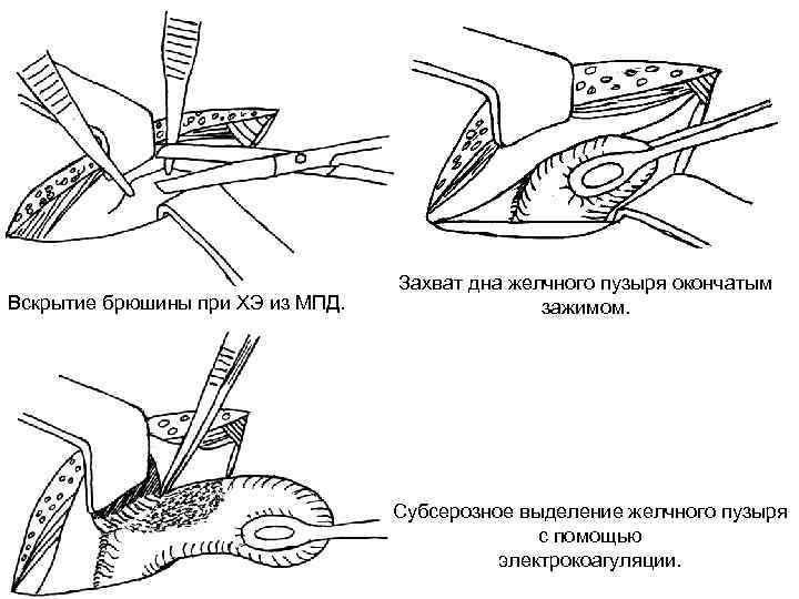 Вскрытие брюшины при ХЭ из МПД. Захват дна желчного пузыря окончатым зажимом. Субсерозное выделение