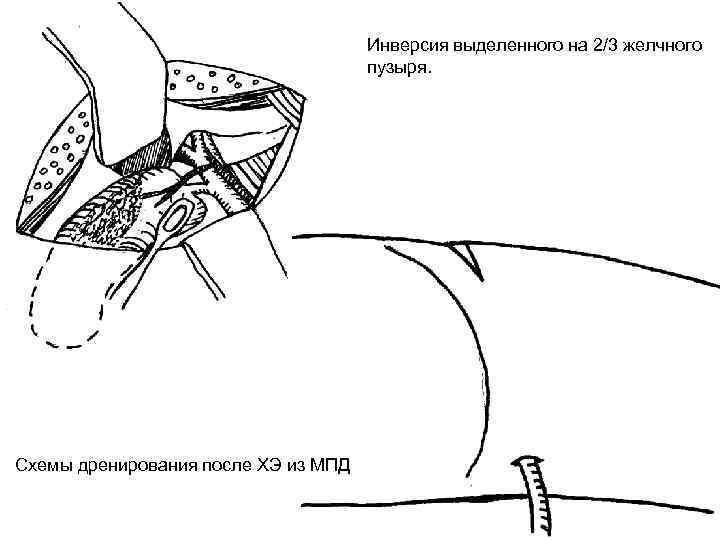 Инверсия выделенного на 2/3 желчного пузыря. Схемы дренирования после ХЭ из МПД 