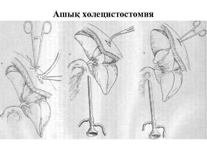 Ашық холецистостомия 