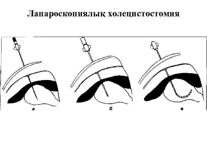 Лапароскопиялық холецистостомия 