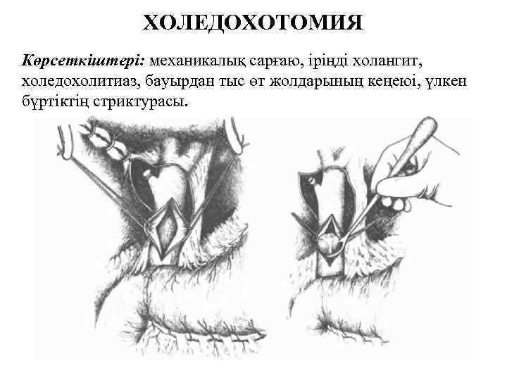 ХОЛЕДОХОТОМИЯ Көрсеткіштері: механикалық сарғаю, іріңді холангит, холедохолитиаз, бауырдан тыс өт жолдарының кеңеюі, үлкен бүртіктің