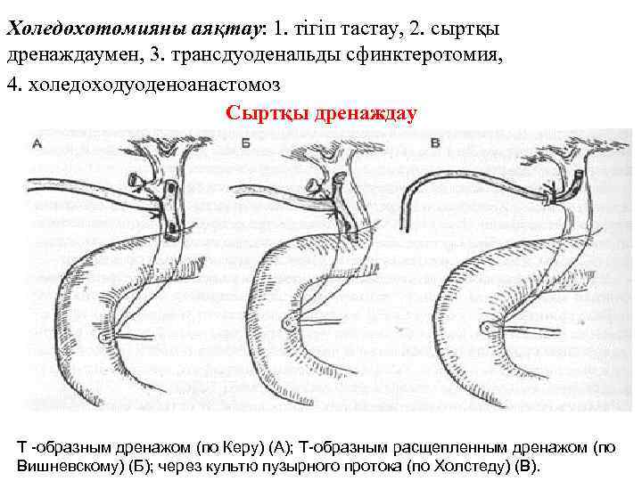 Холедохотомияны аяқтау: 1. тігіп тастау, 2. сыртқы дренаждаумен, 3. трансдуоденальды сфинктеротомия, 4. холедоходуоденоанастомоз Сыртқы