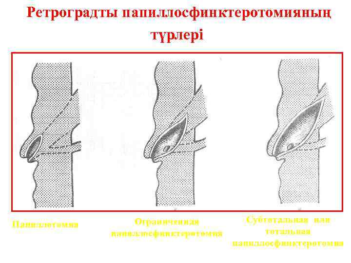 Ретроградты папиллосфинктеротомияның түрлері Папиллотомия Ограниченная папиллосфинктеротомия Субтотальная или тотальная папиллосфинктеротомия 